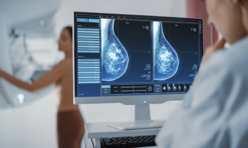 Diagnóstico del cáncer de mama en etapas tempranas