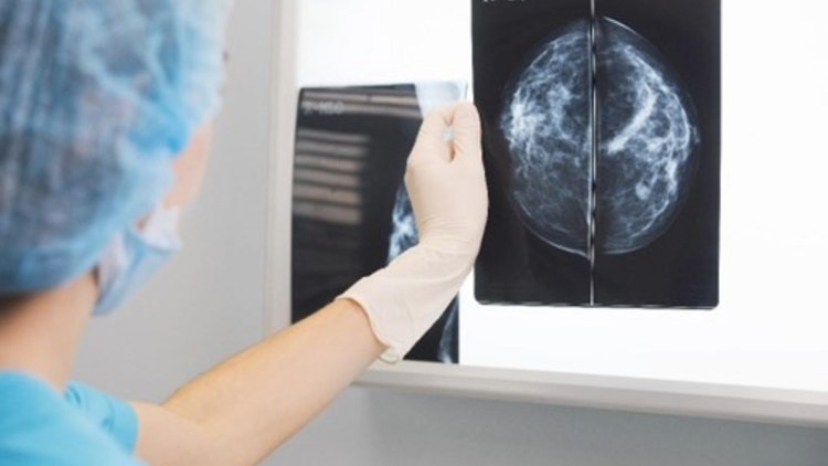 mano sosteniendo una mamografia impresa