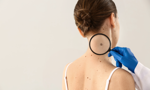 Sobre el Melanoma